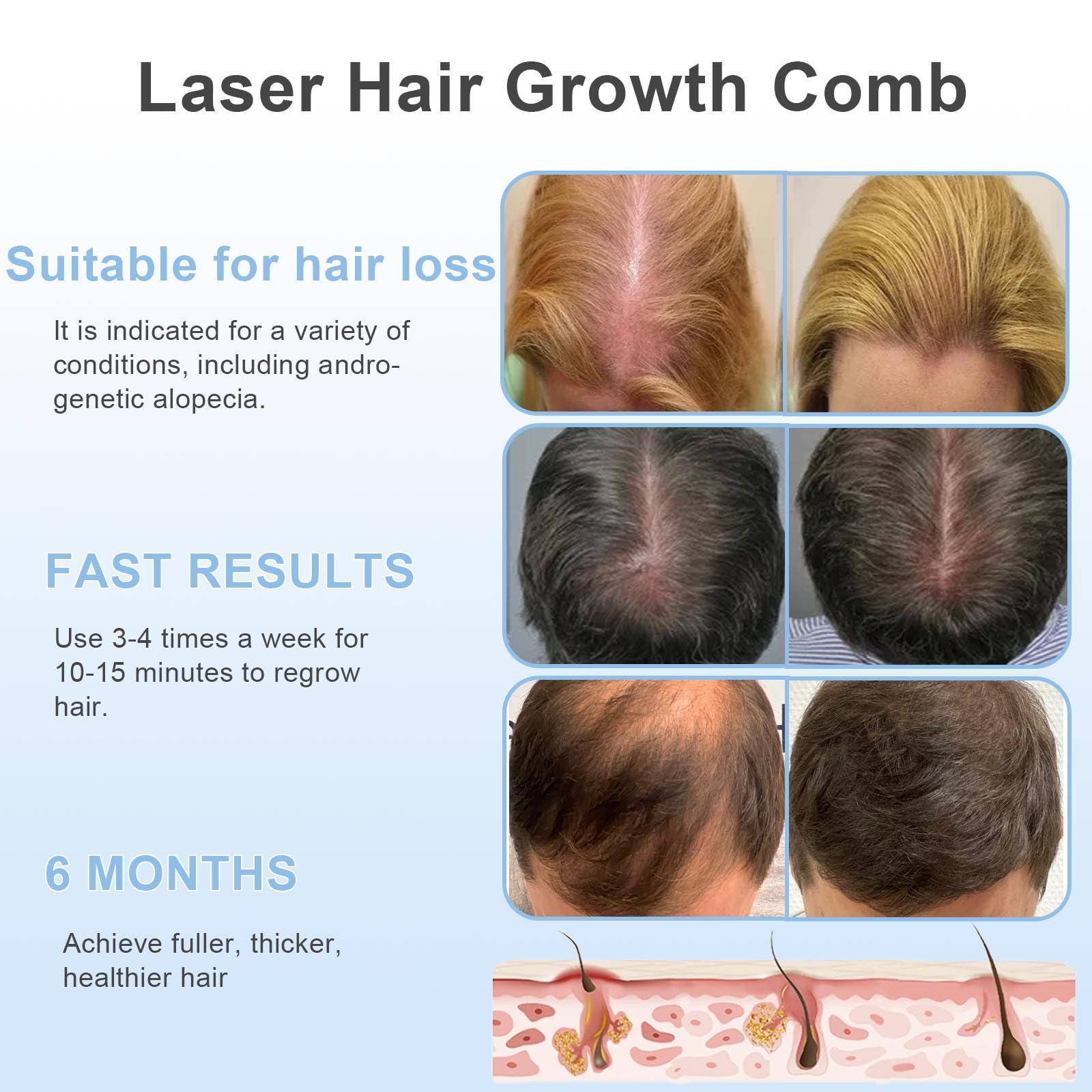 Brosse laser Apbier adressée au cuir chevelu avec exposition ciblée du faisceau.