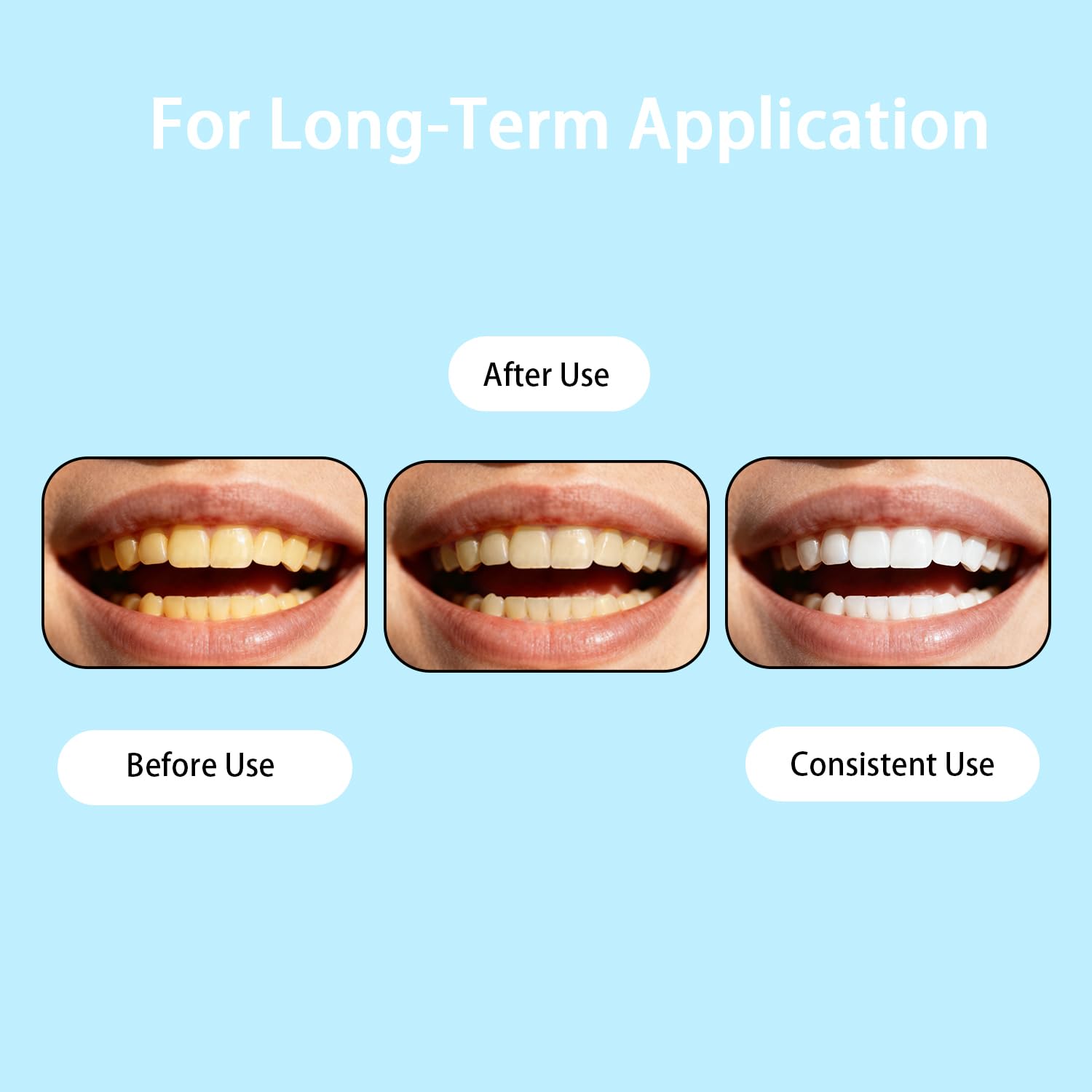 BYXE Liquide Armure Dentaire: application sur les dents pour un renforcement éventuel de l’émail