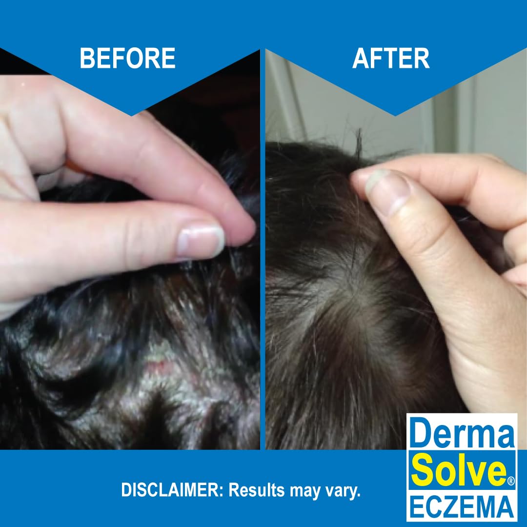 Dermasolve Texture Crème Eczéma – crème légère pour nettoyage doux