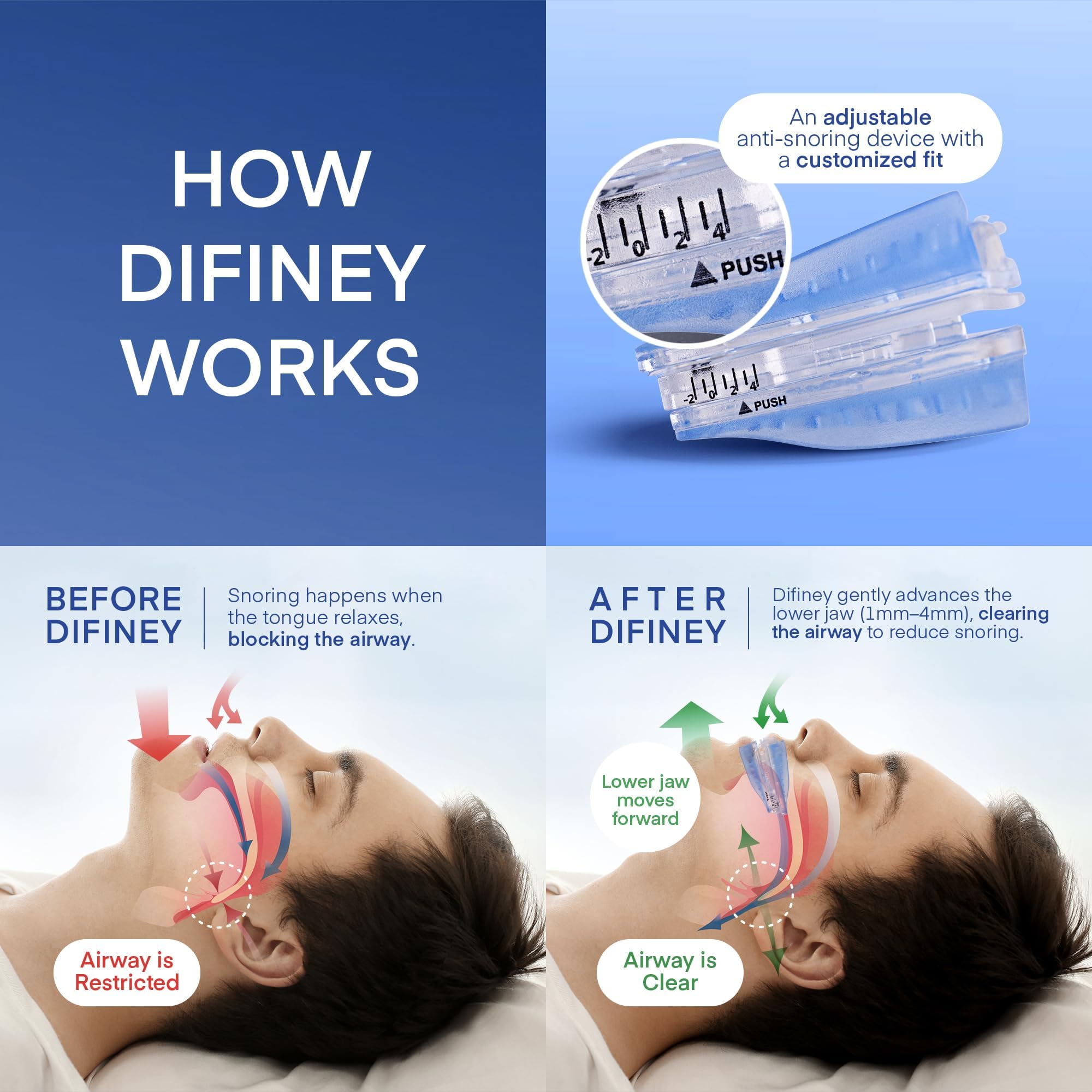 Difiney: matériau médical doux pour un port nocturne confortable.