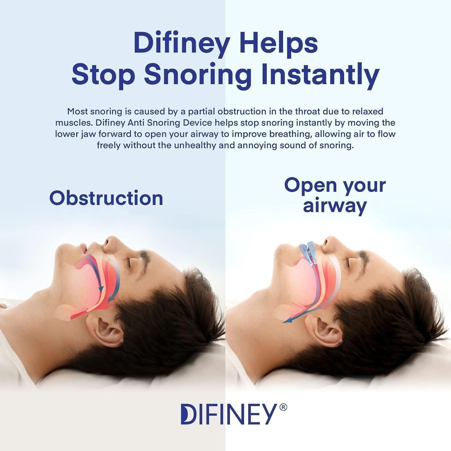 Difiney dispositif anti-ronflement positionnement dents: maintiens quelle que soit votre position