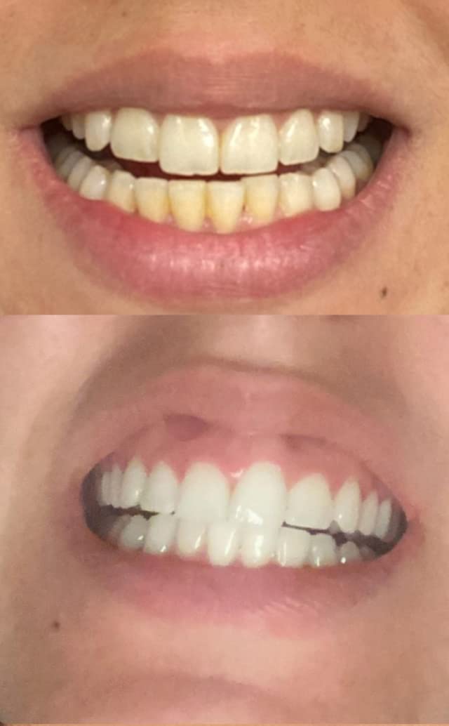 Dr Song gel blanchiment dentaire — application guidée pour éclaircissement progressif à domicile.