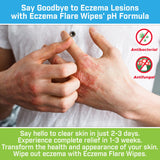 Formule naturelle à base de plantes des Eczema Flare Wipes