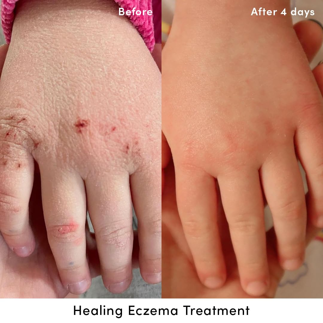 Evereden Crème Eczéma – Application sur les mains sèches pour une hydratation ciblée.