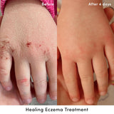 Evereden Crème Eczéma – Application sur les mains sèches pour une hydratation ciblée.