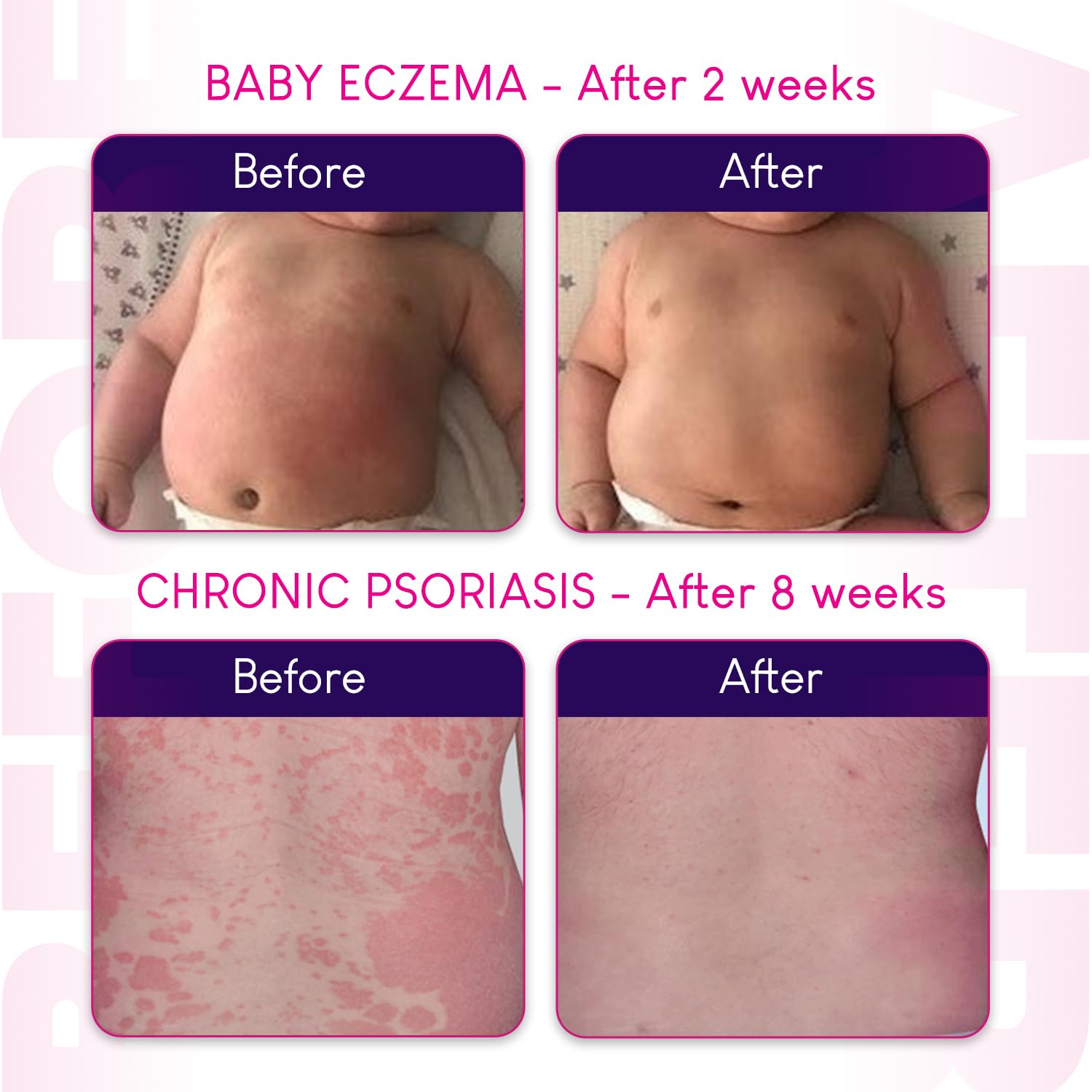 Hope's Relief crème eczéma — ingrédients naturels pour soins quotidiens.
