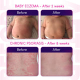 Hope's Relief crème eczéma — ingrédients naturels pour soins quotidiens.