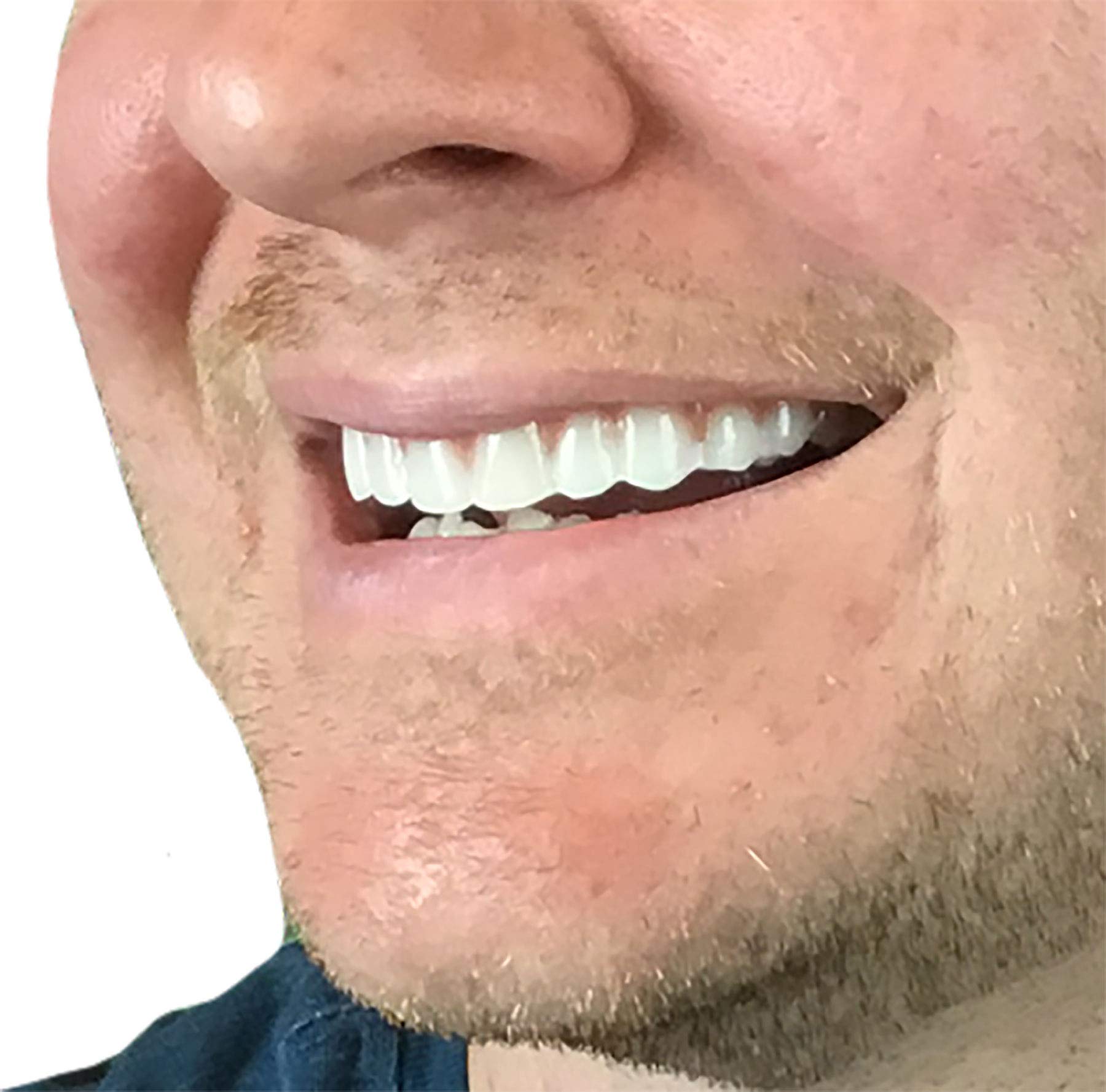 Instant Smile Comfort Fit Flex – Veneer supérieur, teinte claire, confort optimal pendant l’usage.