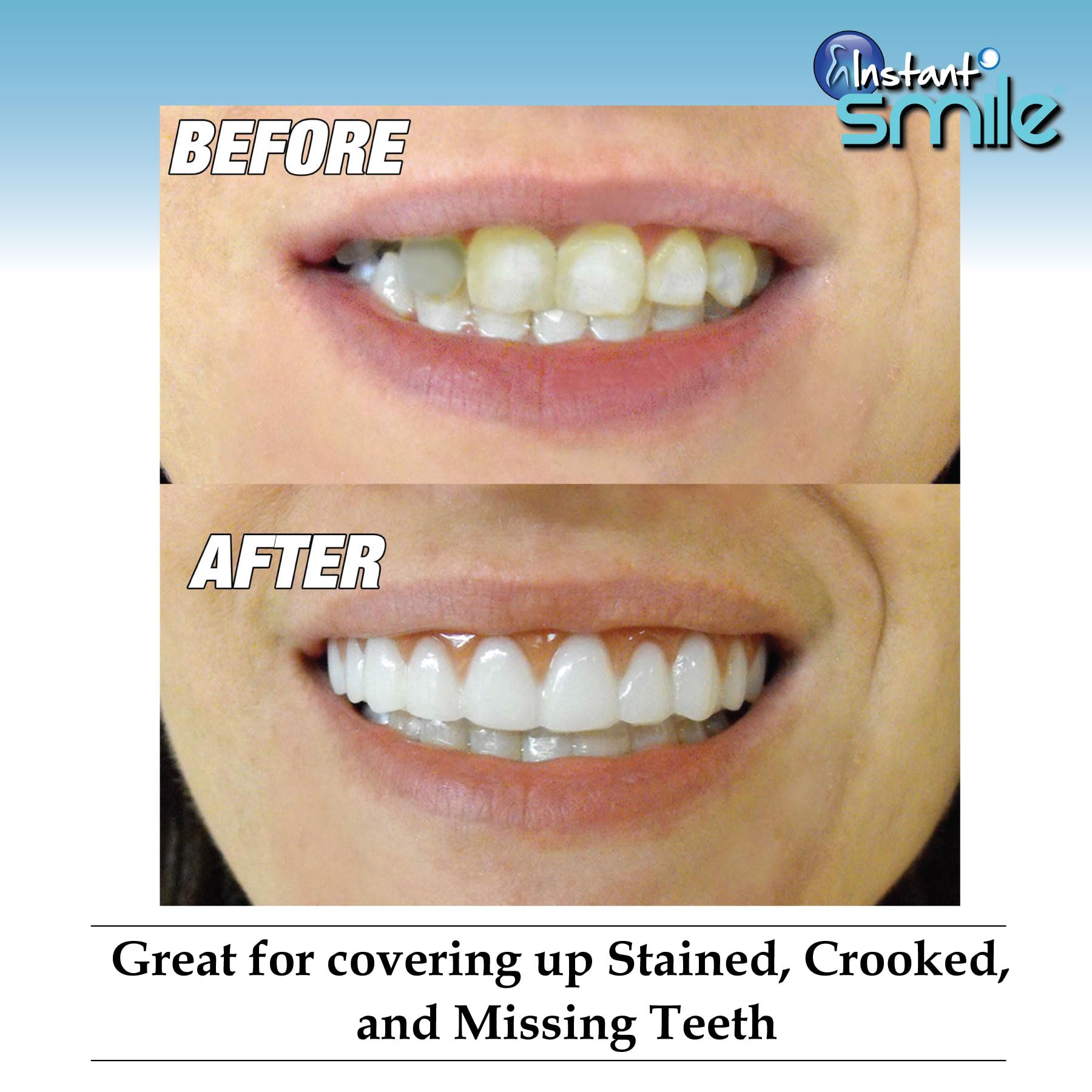 Instant Smile Comfort Fit Flex – Veneer supérieur, teinte claire, technologie ultra-mince à profil flexible.