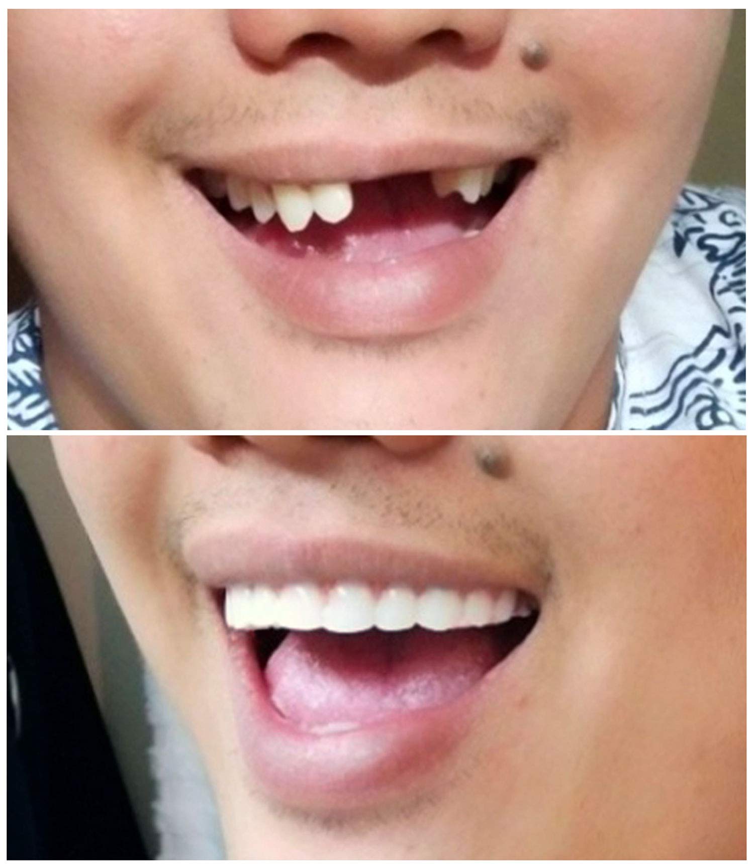 Instant Smile Comfort Fit Flex – Veneer supérieur, teinte claire, référence de taille pour les dents frontales.