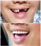 Instant Smile Comfort Fit Flex – Veneer supérieur, teinte claire, référence de taille pour les dents frontales.