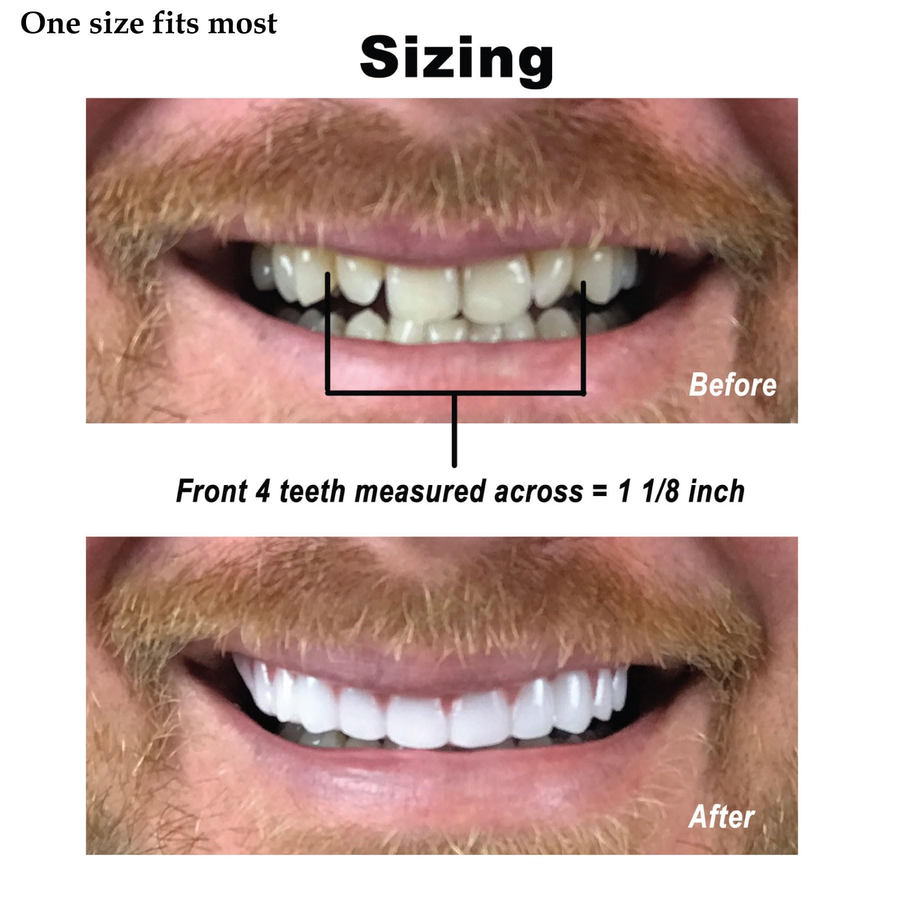 Instant Smile Comfort Fit Flex – Veneer supérieur, teinte claire, solution esthétique portable et discrète.
