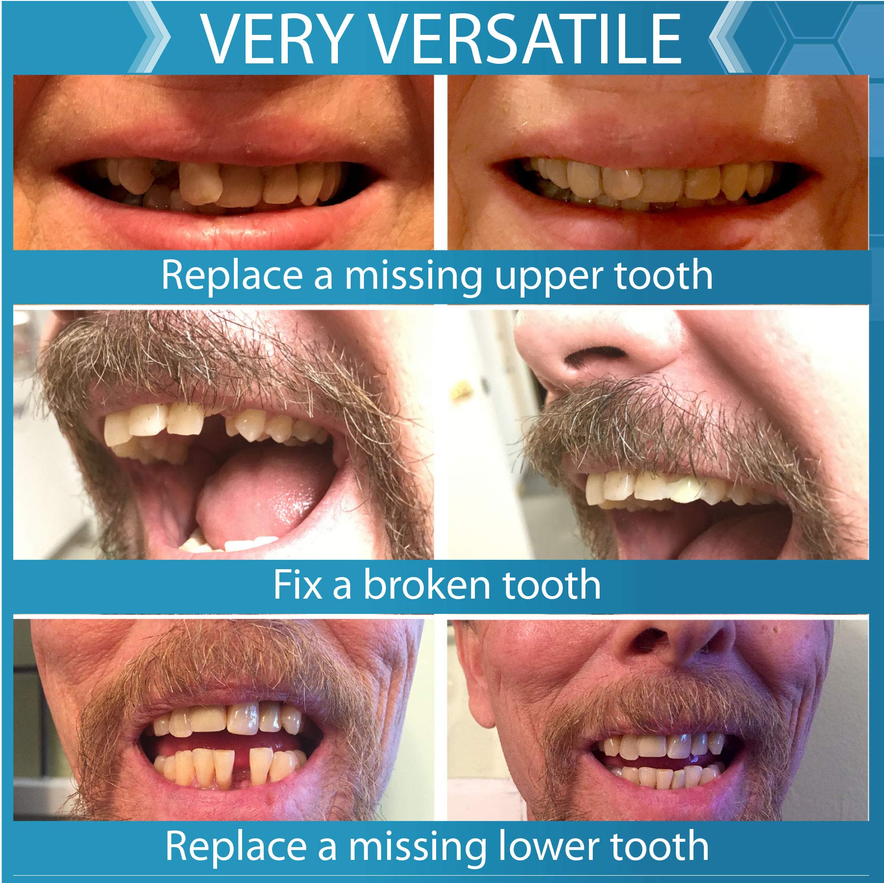 Instant Smile-dent-temporaire-haut-bas : remplacement rapide d'une dent supérieure ou inférieure.