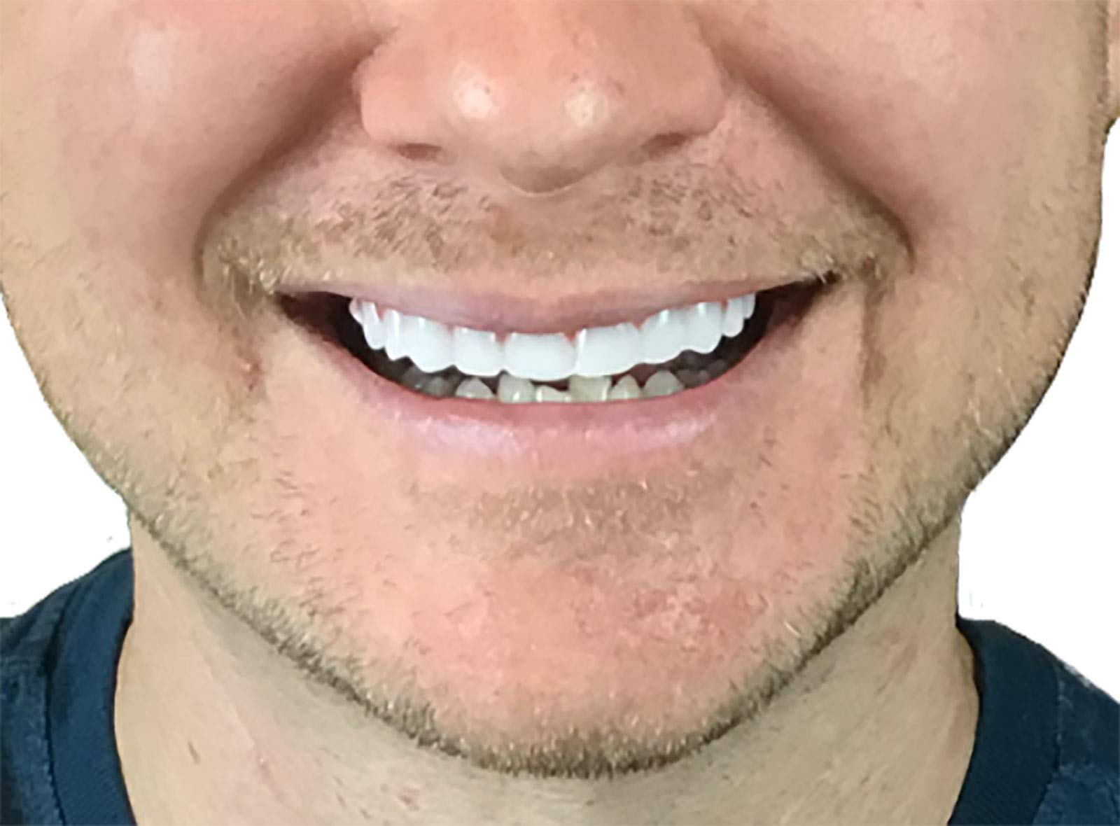 Instant Smile Flex 2pk – ajustement simple pour un alignement discret