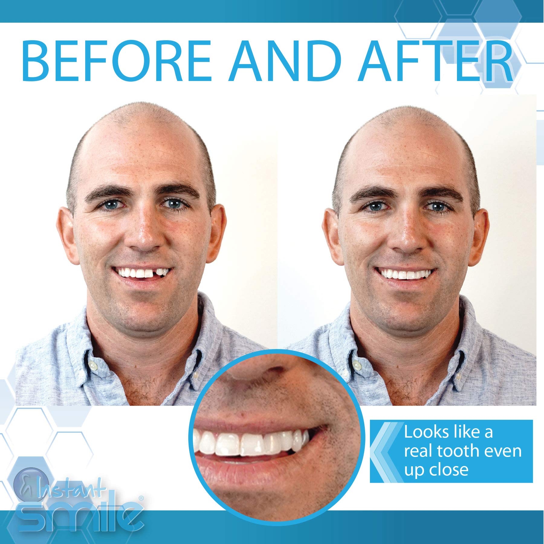 Instant Smile-outils-ajustement-dent : outils inclus pour ajuster la dent avec précision.