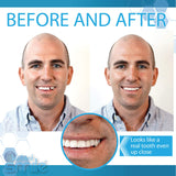 Instant Smile-outils-ajustement-dent : outils inclus pour ajuster la dent avec précision.