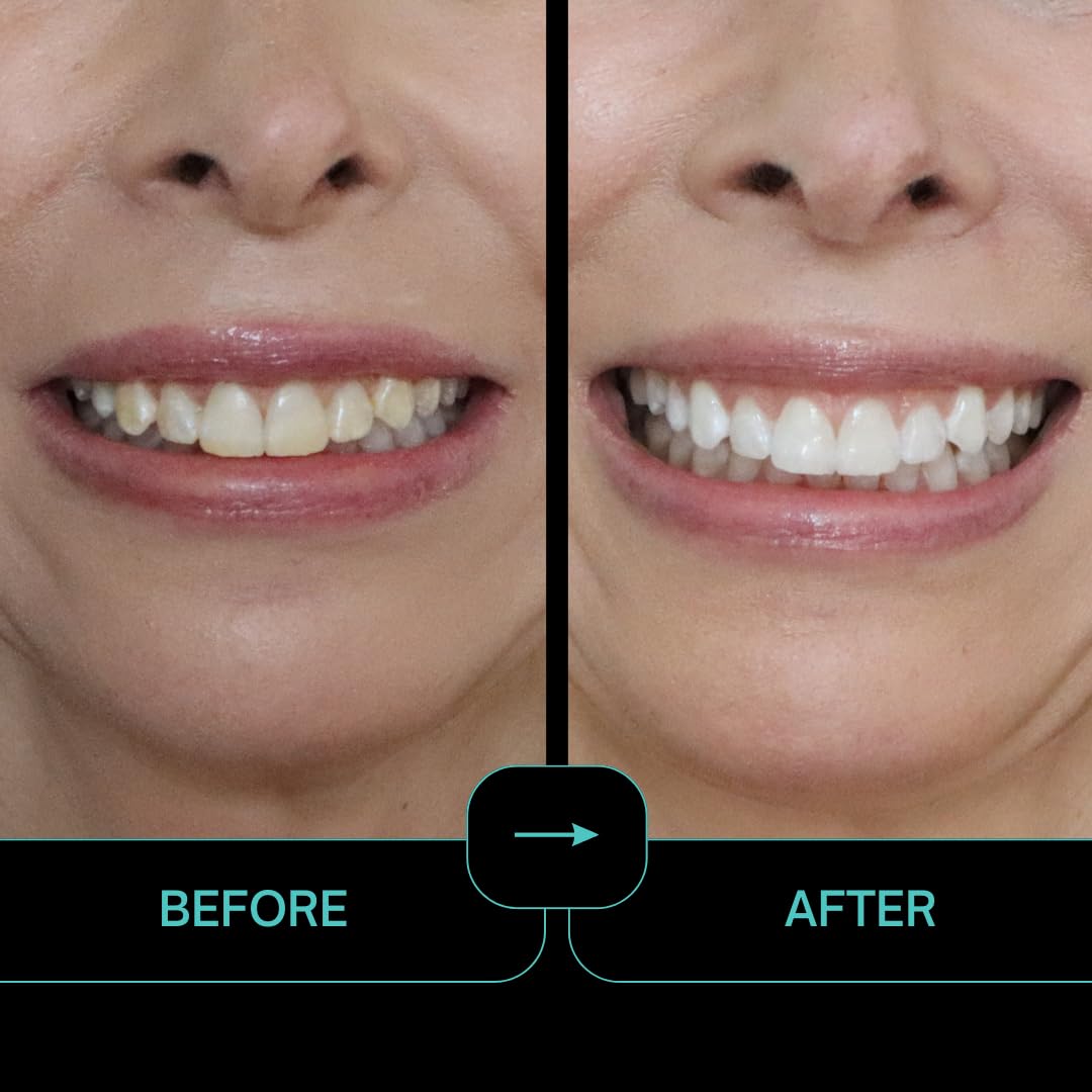 Intelliwhite ProStrips dent blanchiment ciblé avec parfum menthe.