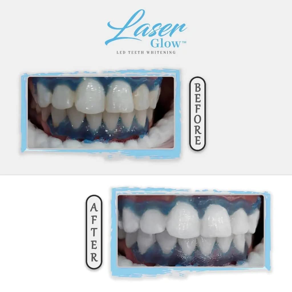 Laser Glow conseils d'entretien pour une brillance durable