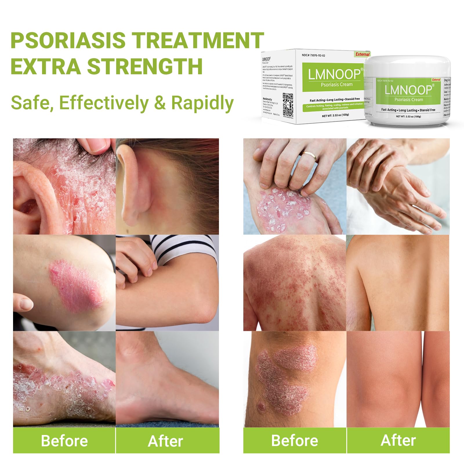 LMNOOP Psoriasis sans parfum, idéal pour peaux sensibles.
