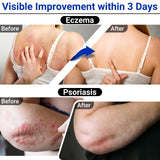 LMNOOP Soin Eczéma Crème – Application facile sur peau sensible et irritée.