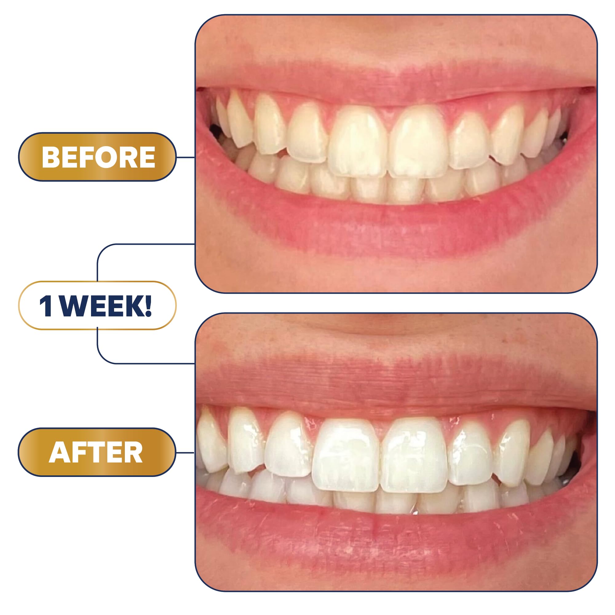 Lumineux Strips Kit – ciblage des taches café et thé pour des dents plus claires