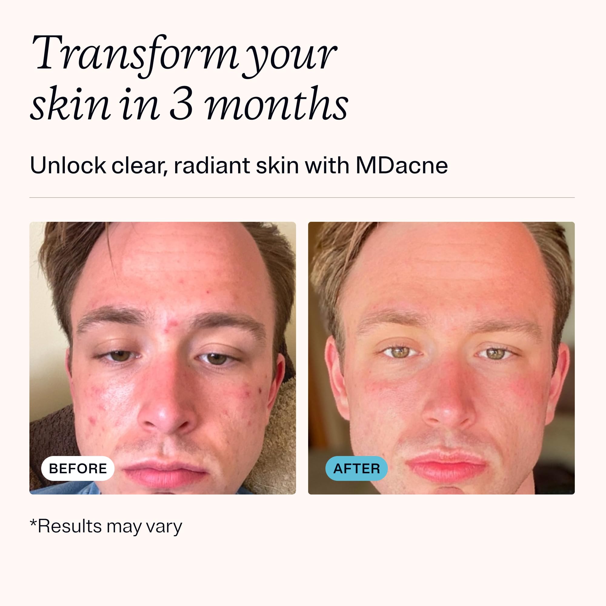 MDacne: ingrédients clés soutenant la peau, cheveux et ongles.