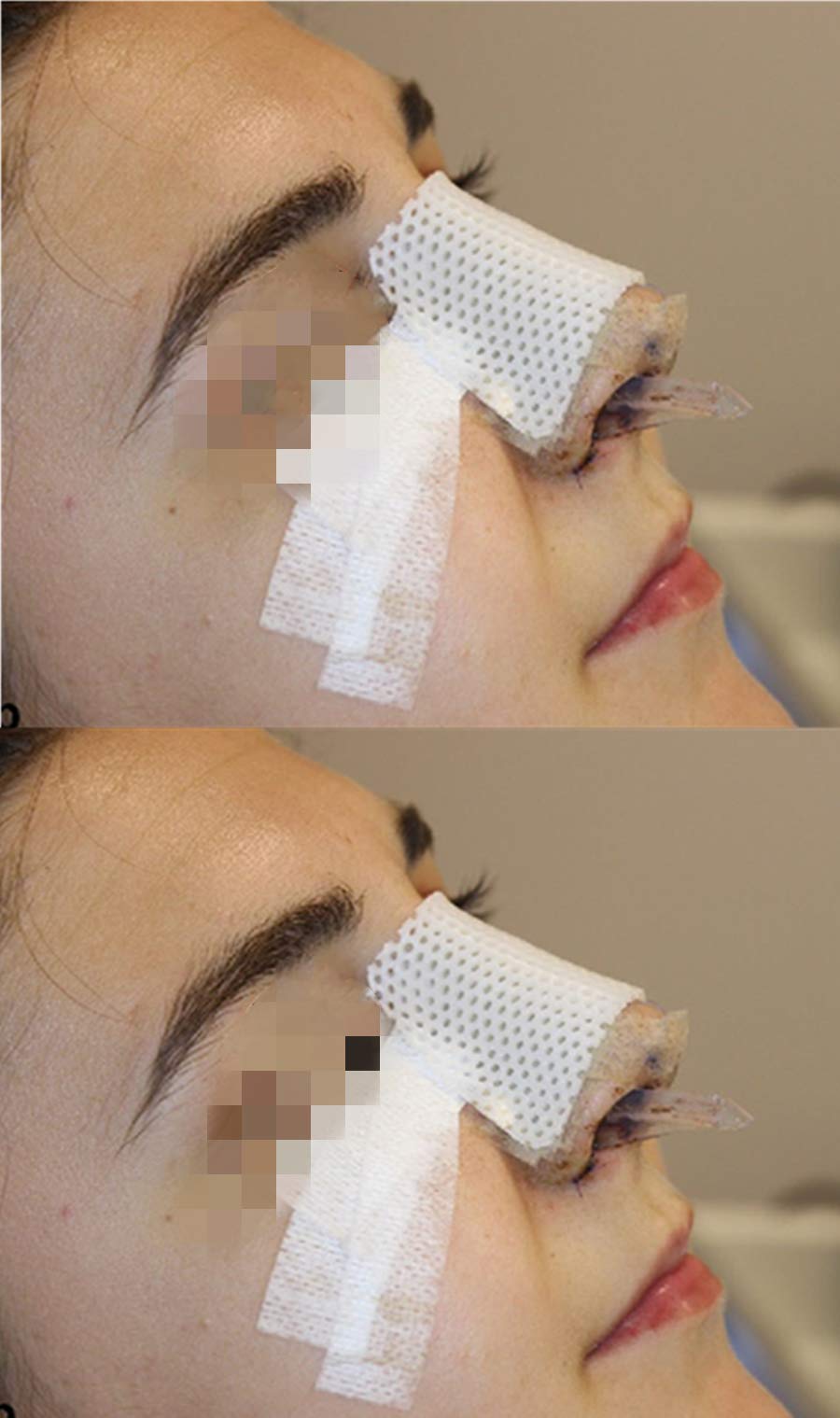 Mediss attelle nasale application sur le nez, ajustement précis