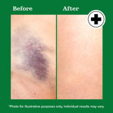 Miracle Plus Arnica Gel – action apaisante après chirurgie.