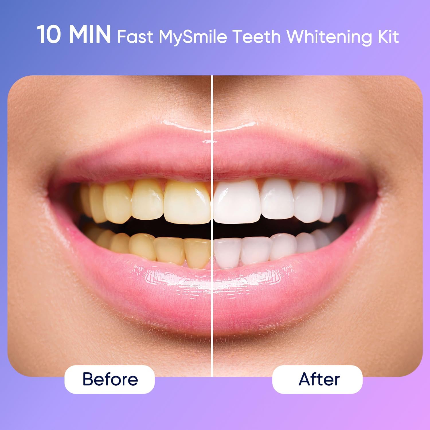 Gel éclaircissant MySmile Deluxe 35% carbamide, formule douce et efficace.