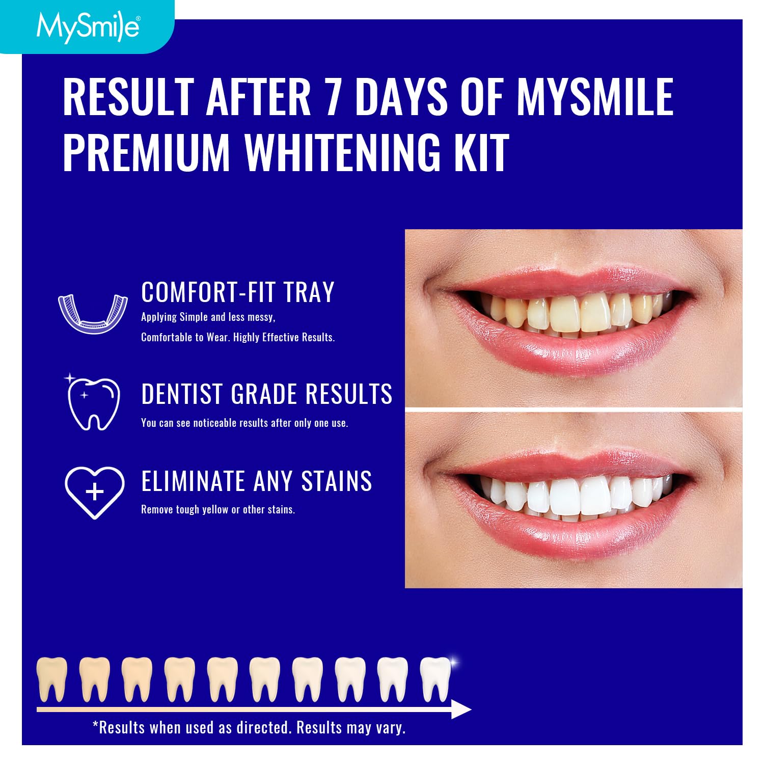 MySmile gouttières haut et bas : adaptation confortable pour tous les dents