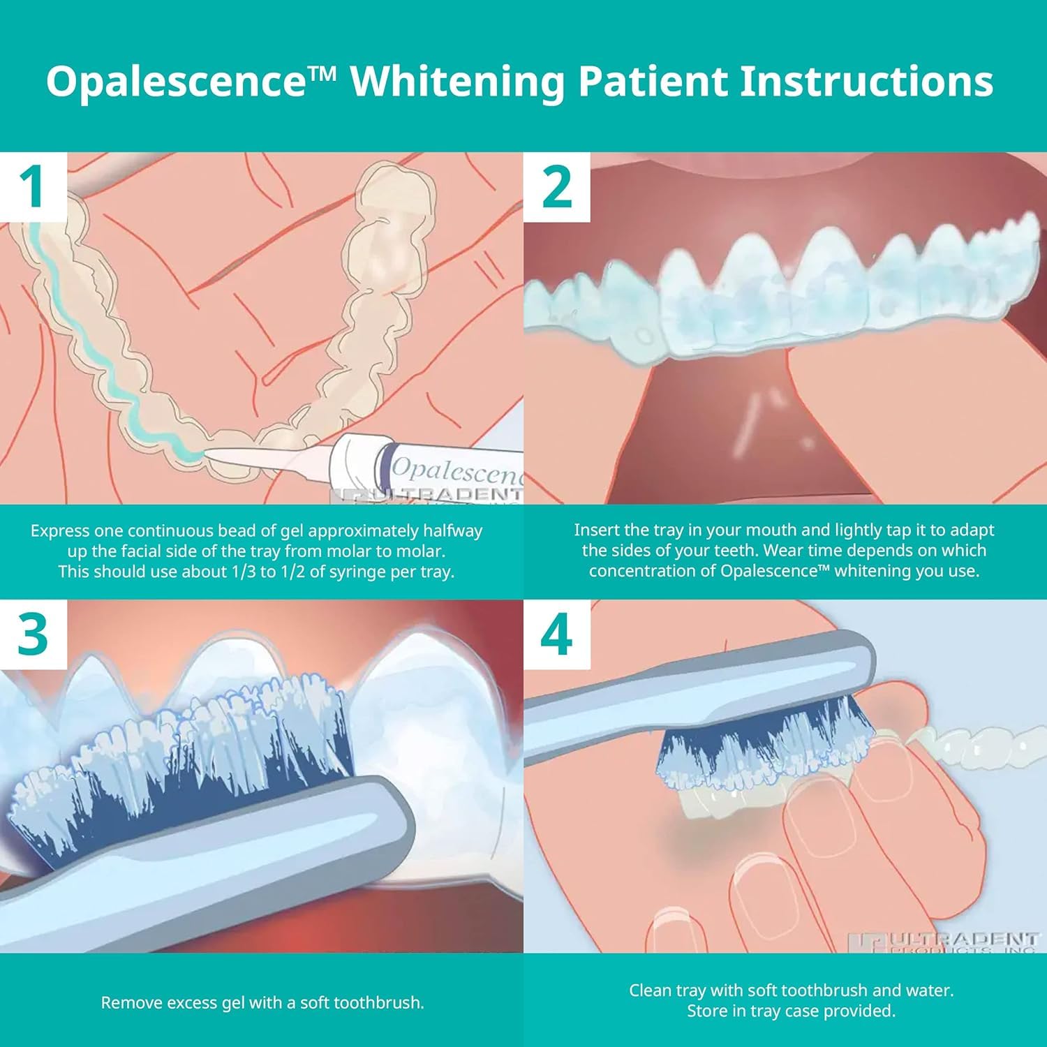 Opalescence 35% CP Menthe – gouttière dentaire compatible pour le blanchiment.
