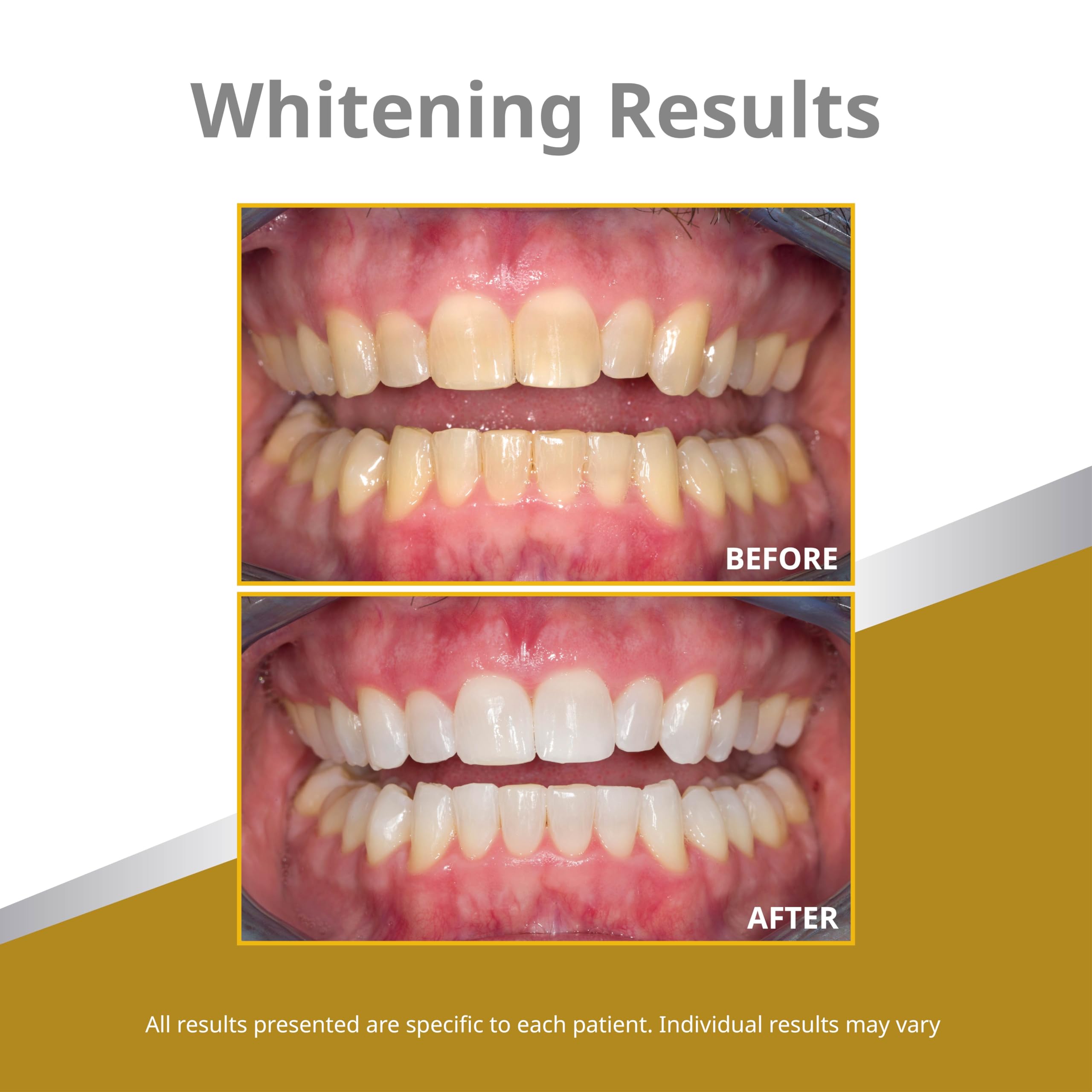 Opalescence tray compatible Invisalign menthe: compatible avec Invisalign pour une utilisation discrète.