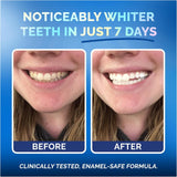 POP ON VENEERS sans peroxyde privilégie un blanchiment doux