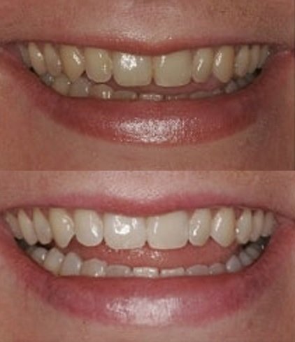 ProDental gel blanchiment 60 traitements – solution économique et efficace
