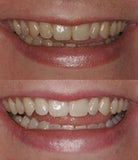 ProDental gel blanchiment 60 traitements – solution économique et efficace
