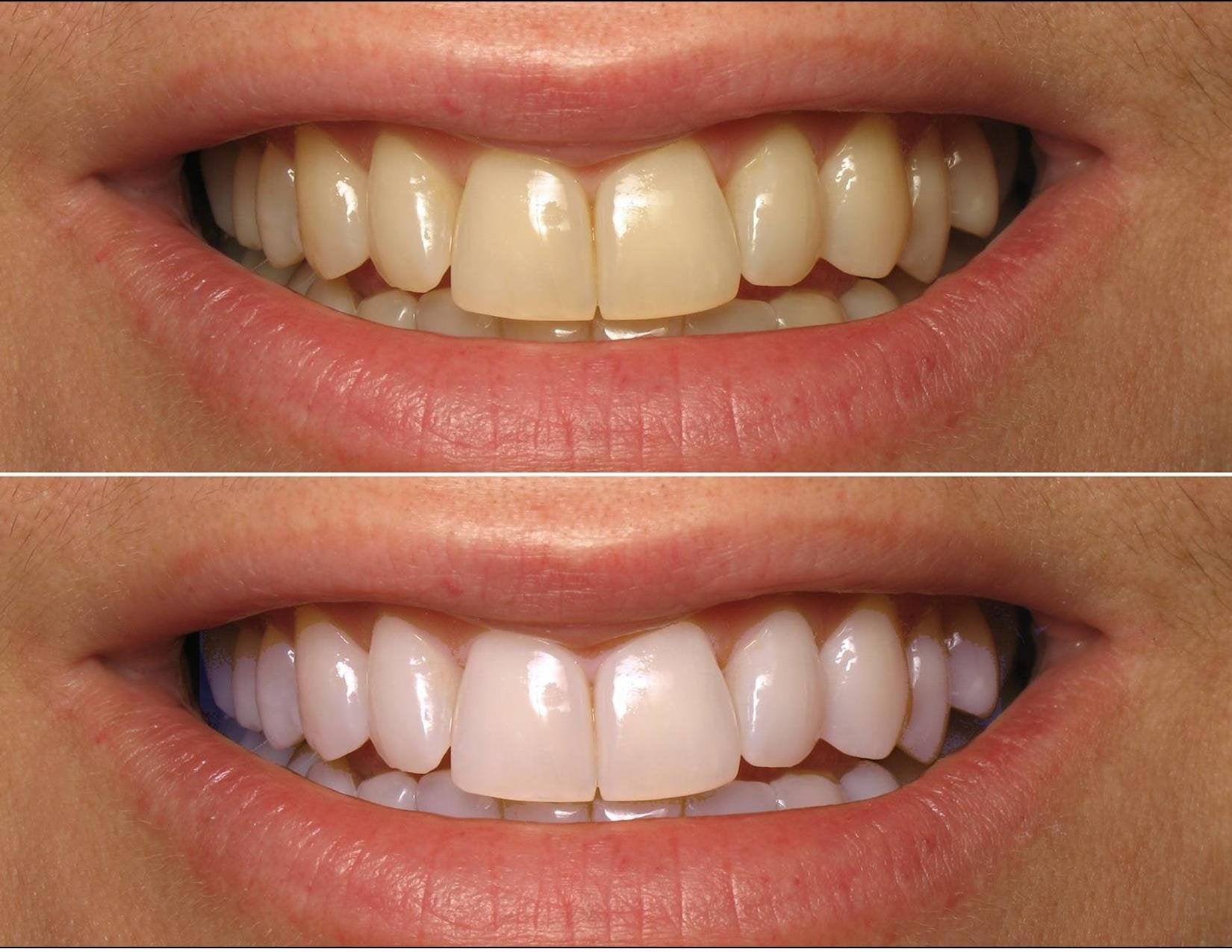 ProDental seringues 3 ml – dosage précis pour un blanchiment sûr