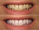 ProDental seringues 3 ml – dosage précis pour un blanchiment sûr
