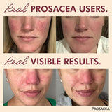Prosacea gel absorption rapide, texture légère idéale sous maquillage