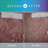 Prosoria texture gel et pommade expérience sensorielle agréable lors de l’application.
