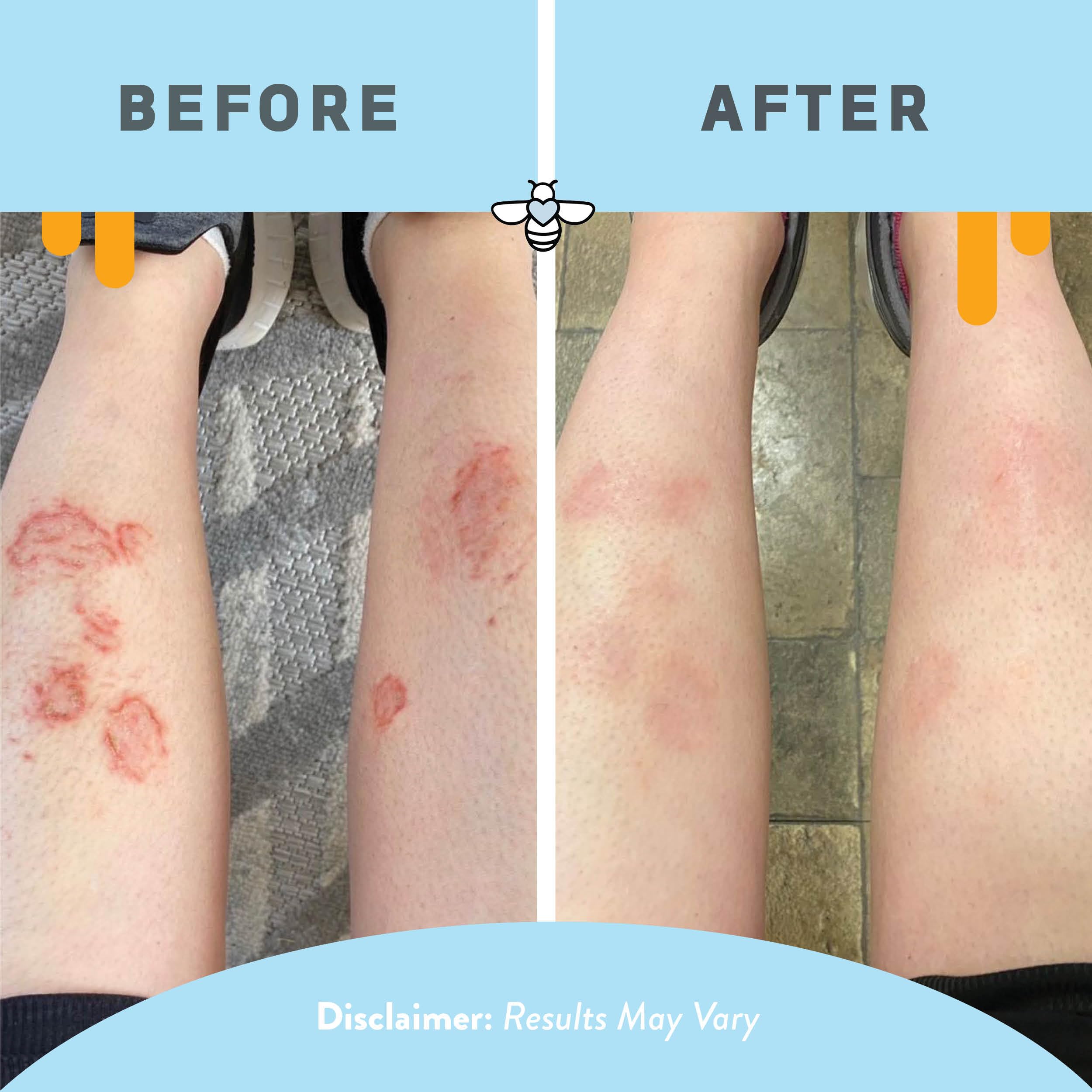 PSORIASIS HONEY: texture légère et non grasse adaptée à toute la famille.