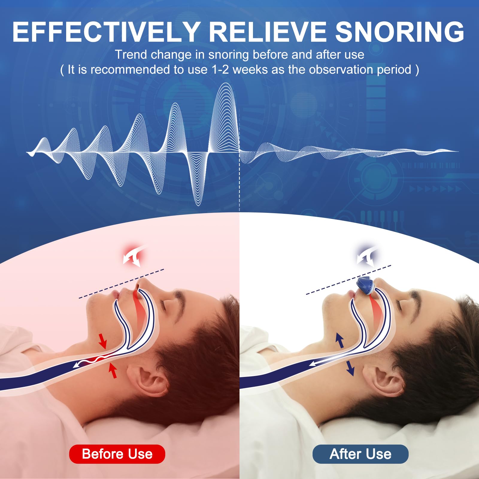 Redpee dilatateurs nasaux ajustables en bleu, s’adaptant à toutes les formes de nez.