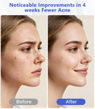 RUPUQIRA lumière rouge LED pour le visage, soin ciblé et efficace.