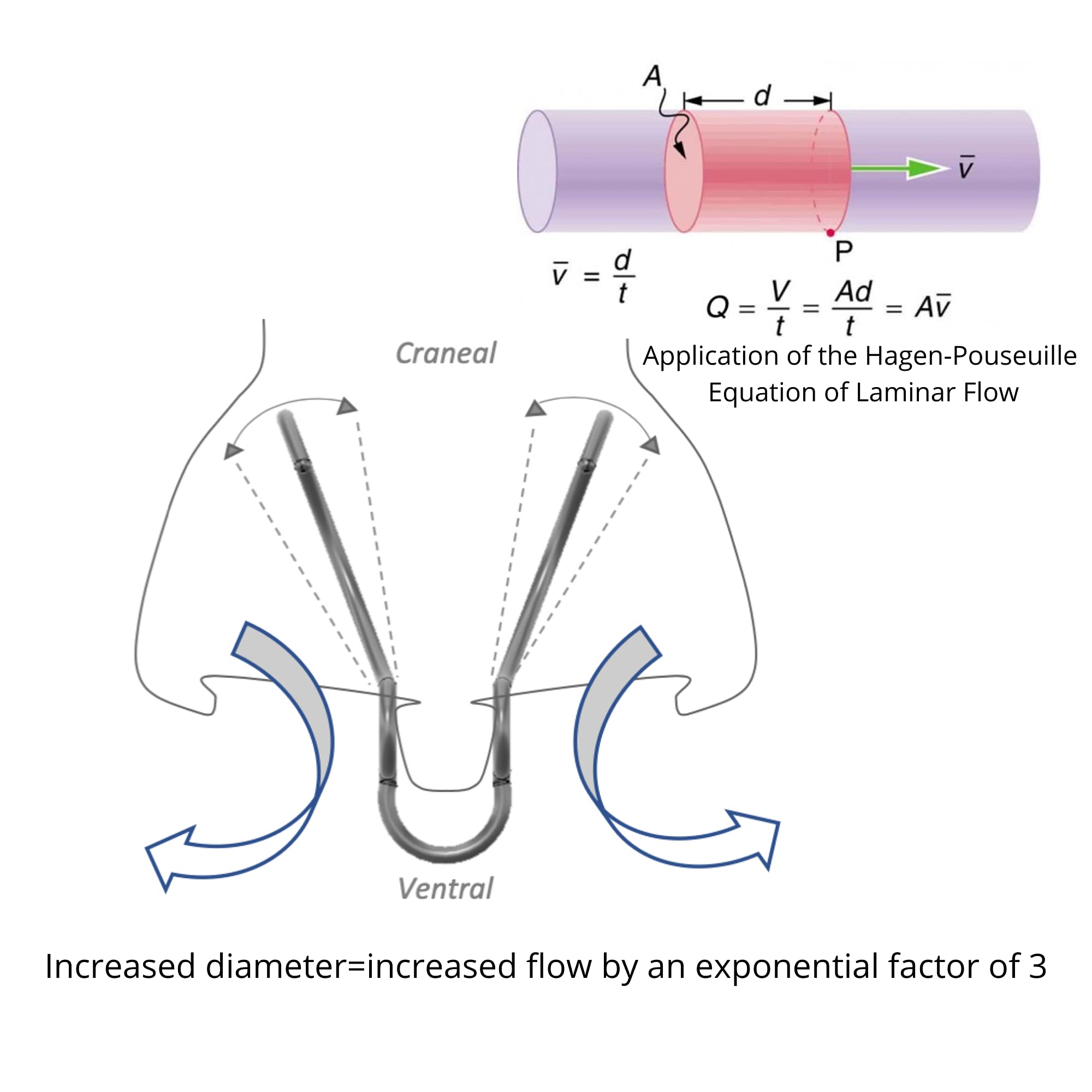Silent Mammoth dilateur nasal réutilisable jusqu'à 60 jours avec entretien simple.