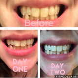 Smile Titan seringues blanchiment 44% 4x : application précise à domicile