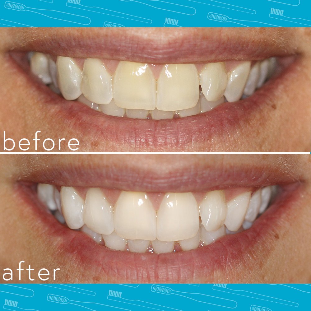Smileactives gel-blanchissant-peroxyde-dentaire agit rapidement