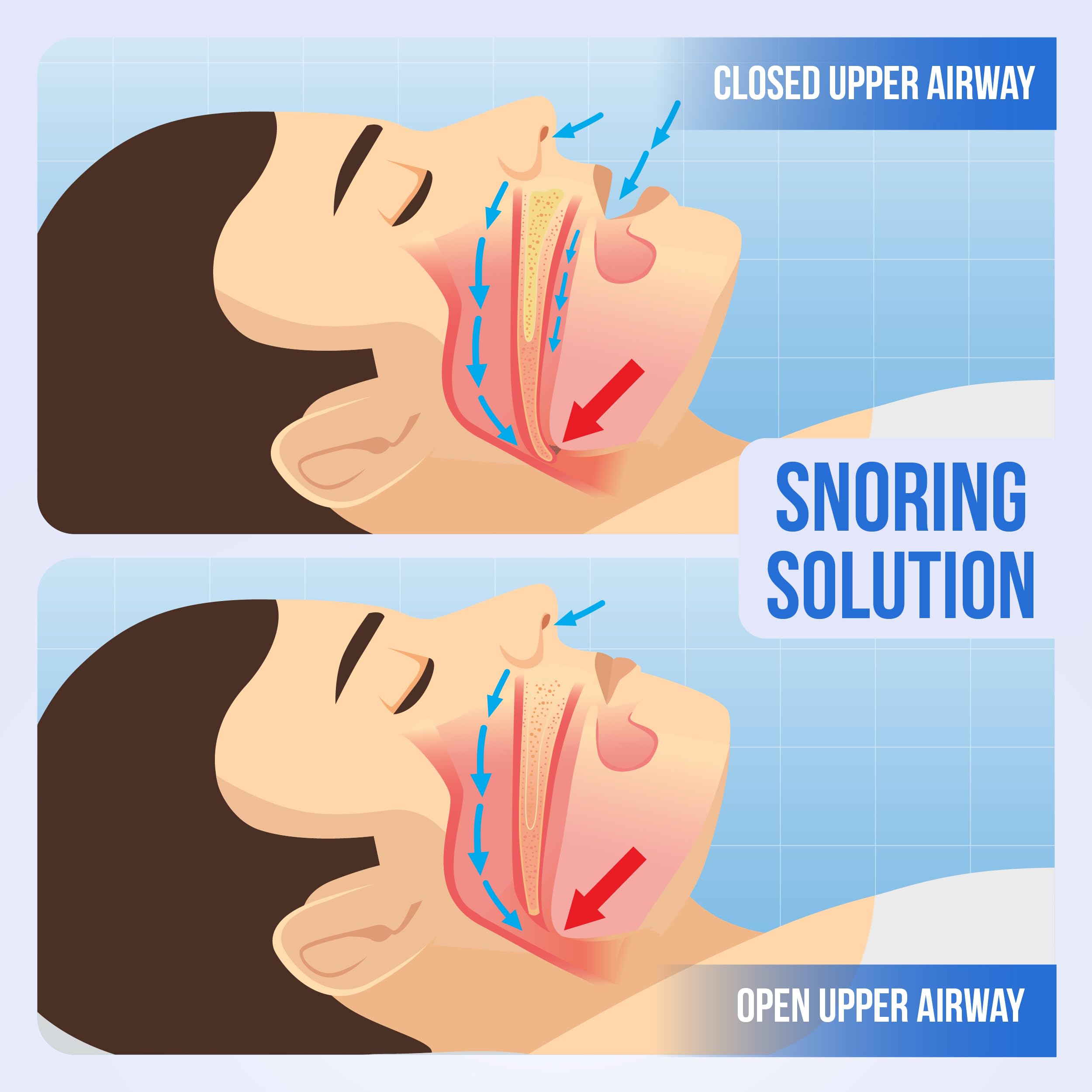 SnoreGuard lavage quotidien : nettoyage facile après chaque utilisation.