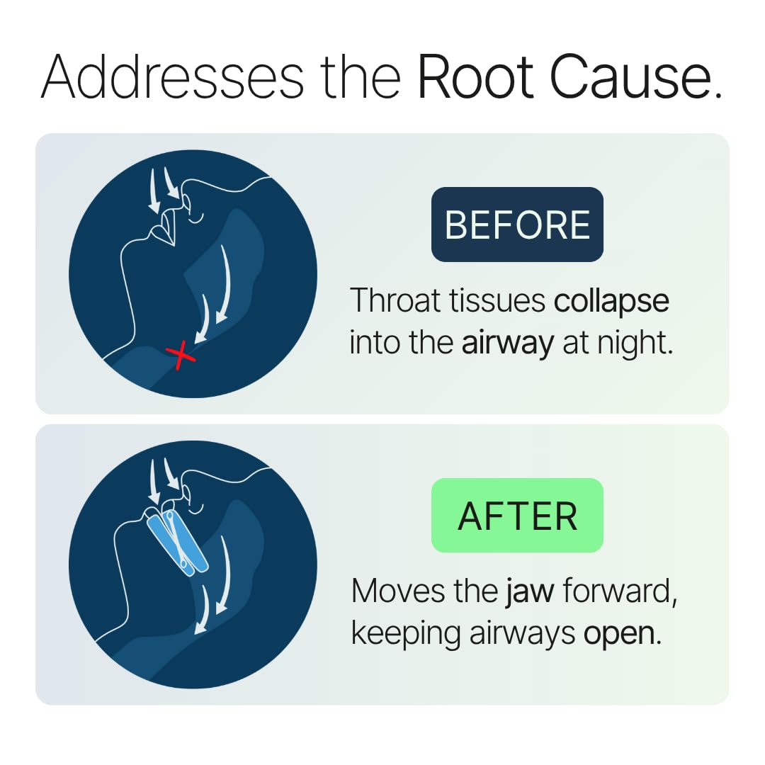 Somnofit-S confort toute la nuit – pour un sommeil plus paisible et sans interruptions.