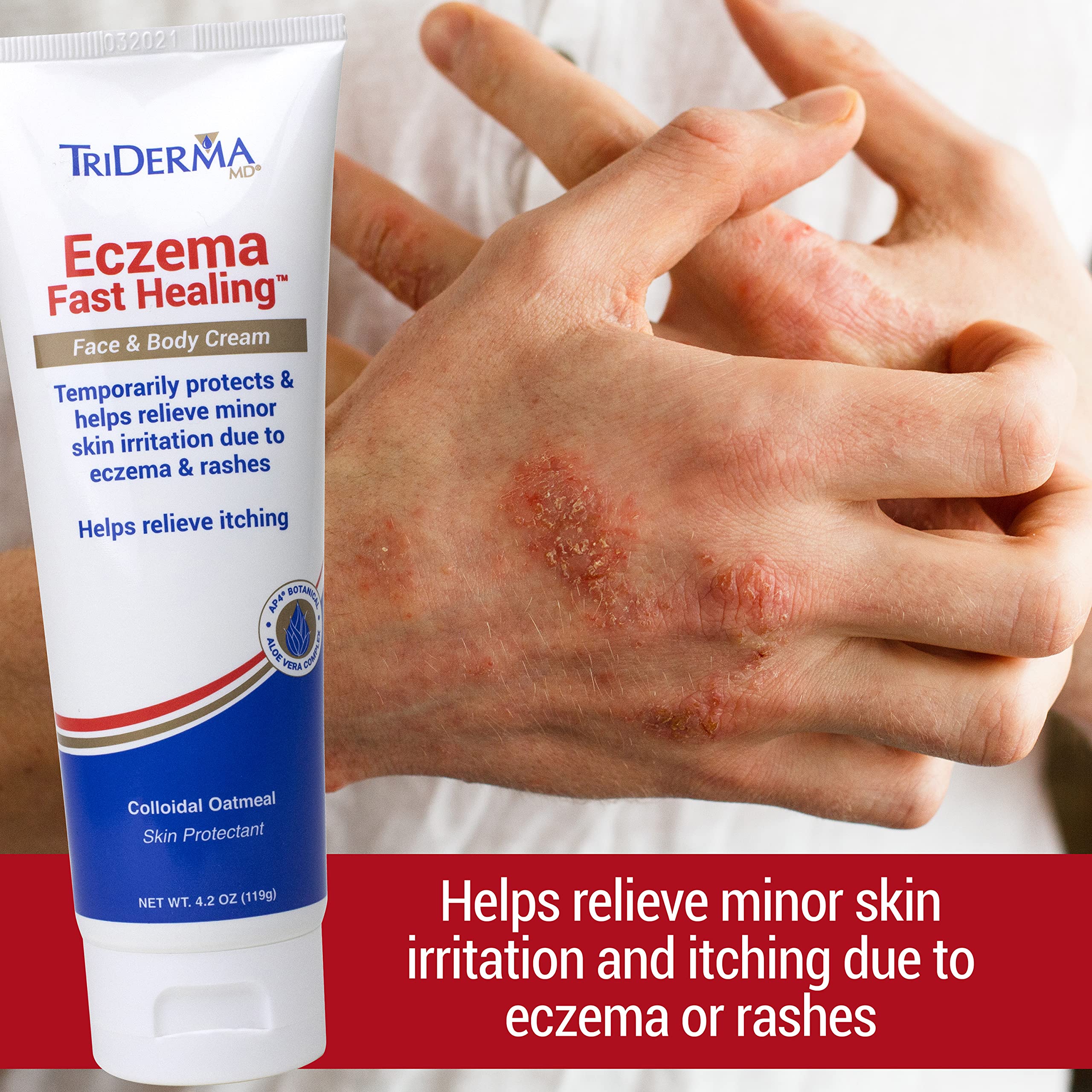 TriDerma Crème Eczéma application sur les mains pour peau irritée.
