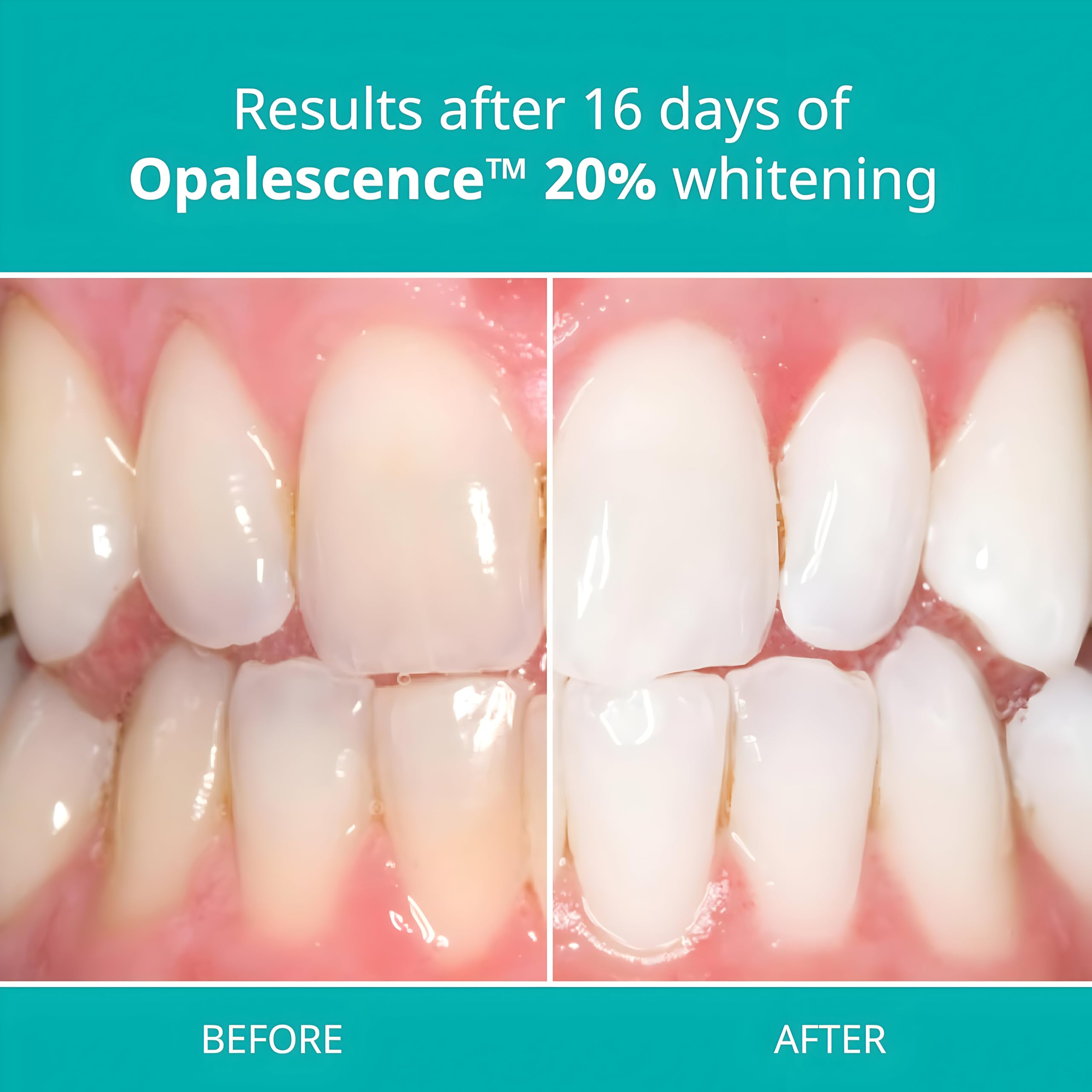 ULTRADENT Opalescence PF 20% – application précise sur gouttière dentaire.
