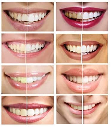 Utilisation délicate sans contact avec les gencives avec White Teeth Global